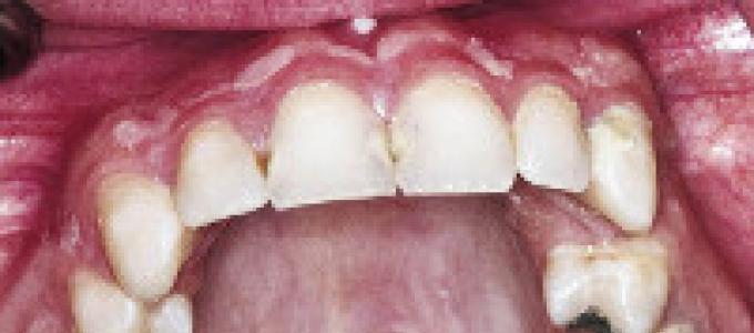 Осложнения во время удаления зуба-вывих и перелом нижней челюсти Лечение перелома альвеолярного отростка